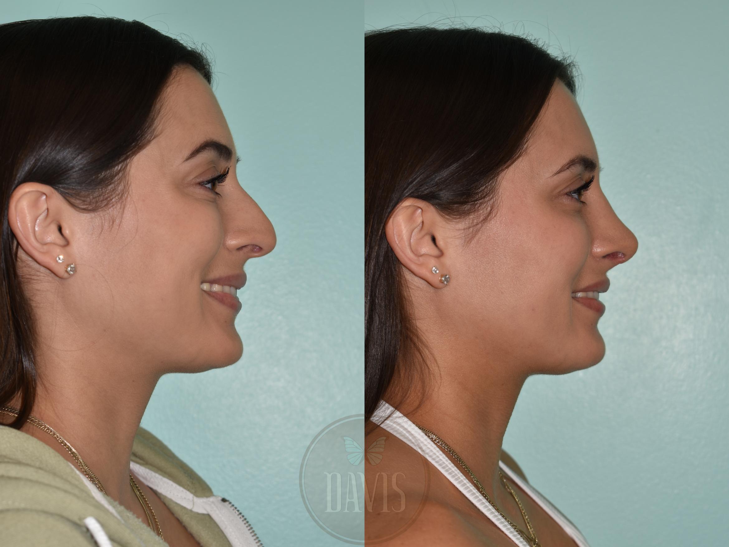 Before & After Female Rhinoplasty Case 1174 Left Side View in Tampa, FL