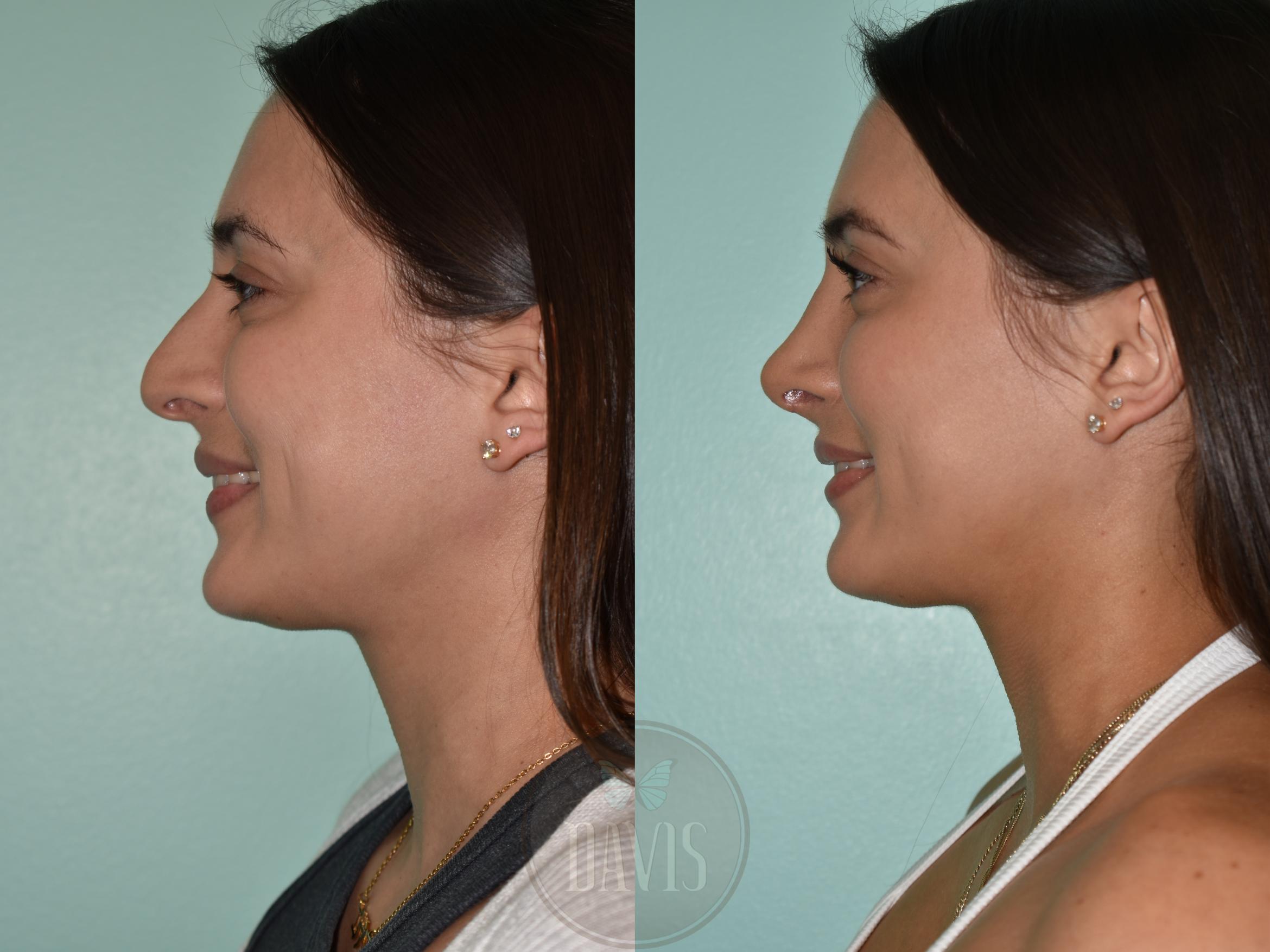 Before & After Female Rhinoplasty Case 1174 Right Oblique View in Tampa, FL