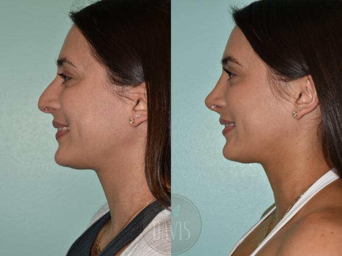 Before & After Female Rhinoplasty Case 1174 Right Oblique View in Tampa, FL