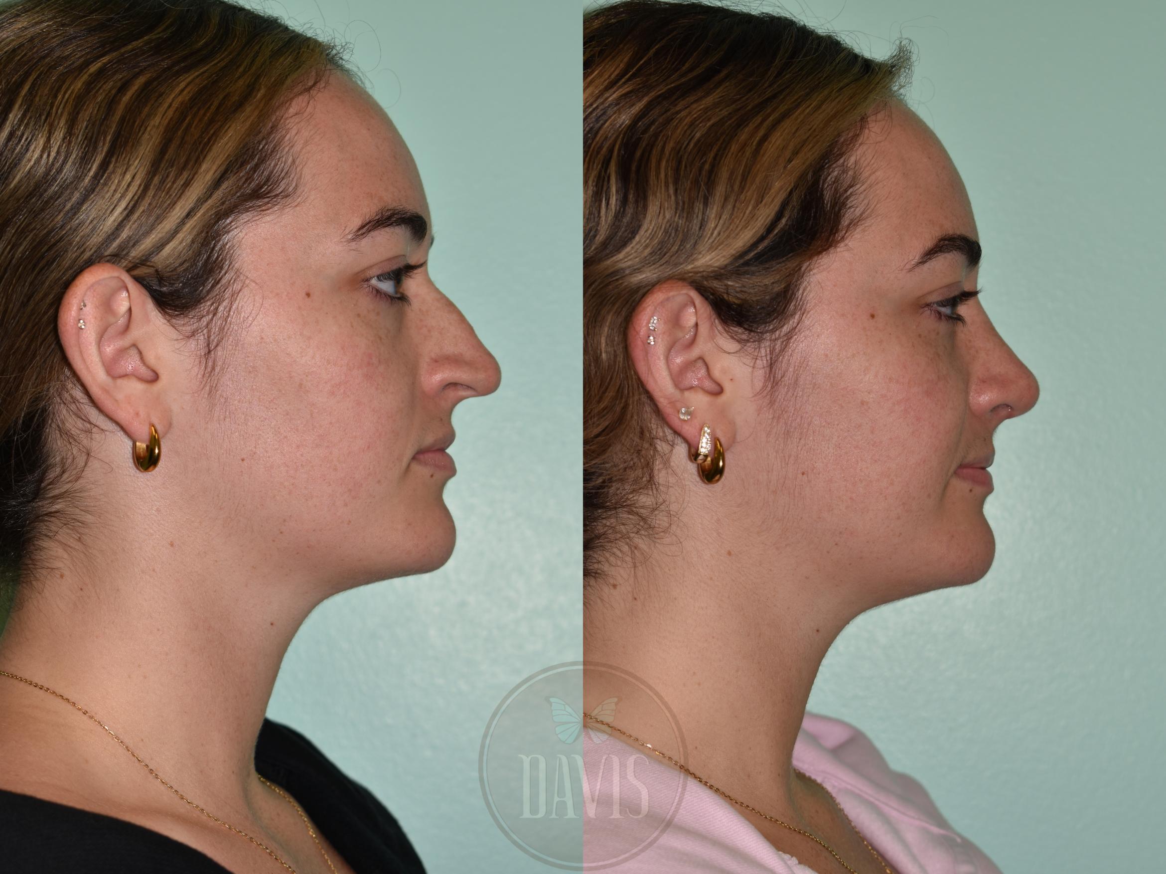 Before & After Female Rhinoplasty Case 1175 Front View in Tampa, FL