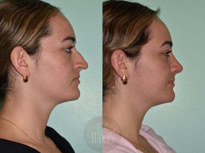 Before & After Female Rhinoplasty Case 1175 Front View in Tampa, FL