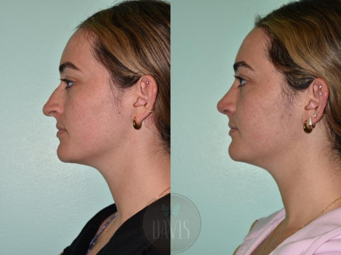 Before & After Female Rhinoplasty Case 1175 Left Oblique View in Tampa, FL