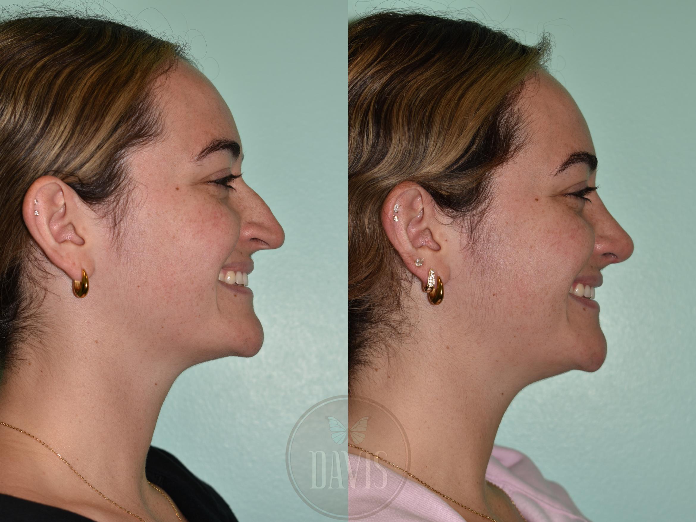Before & After Female Rhinoplasty Case 1175 Left Side View in Tampa, FL