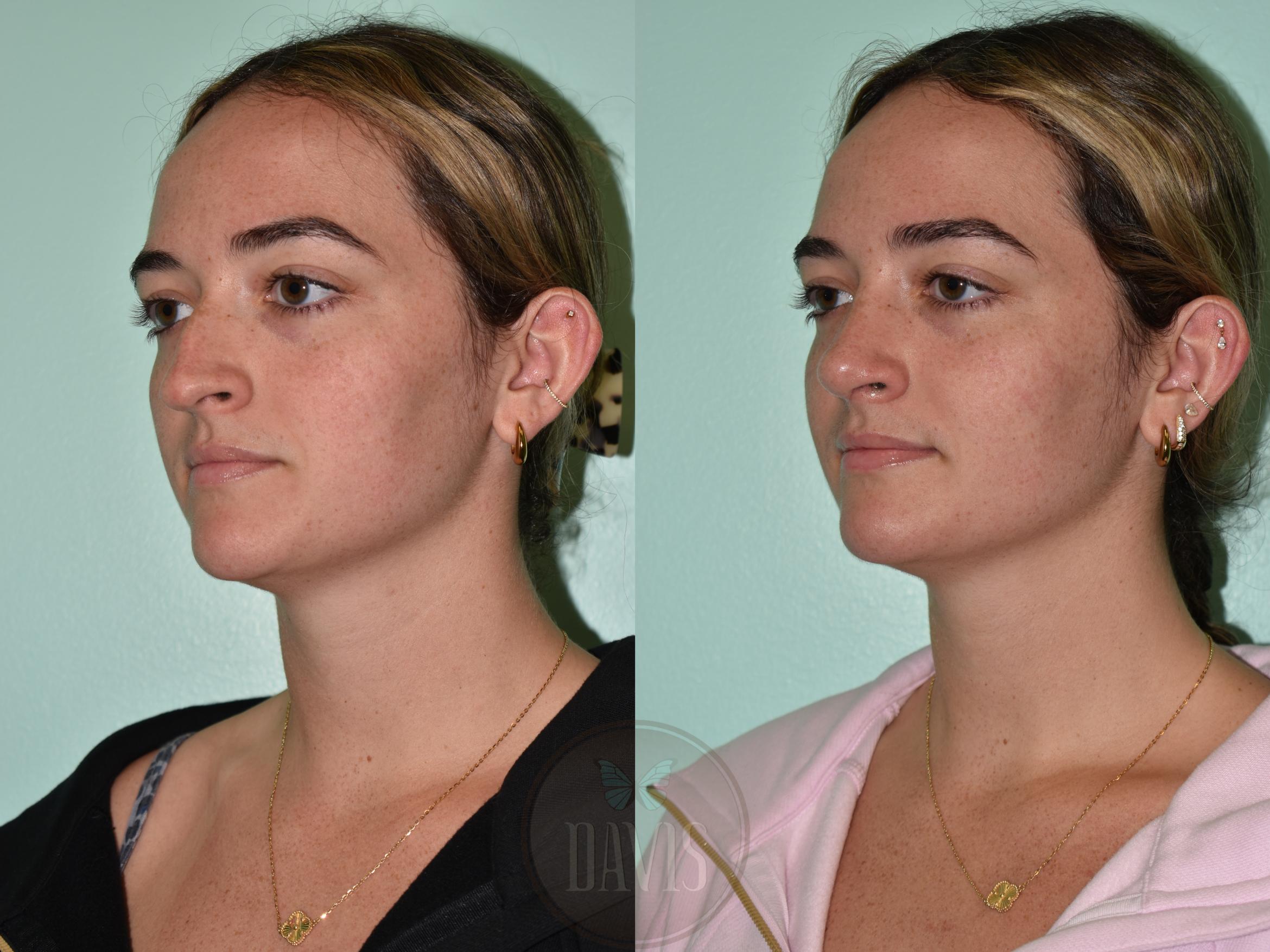 Before & After Female Rhinoplasty Case 1175 Right Side View in Tampa, FL