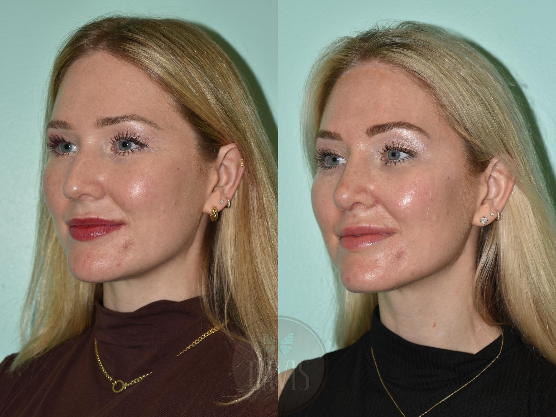 Before & After Female Rhinoplasty Case 1176 Front View in Tampa, FL
