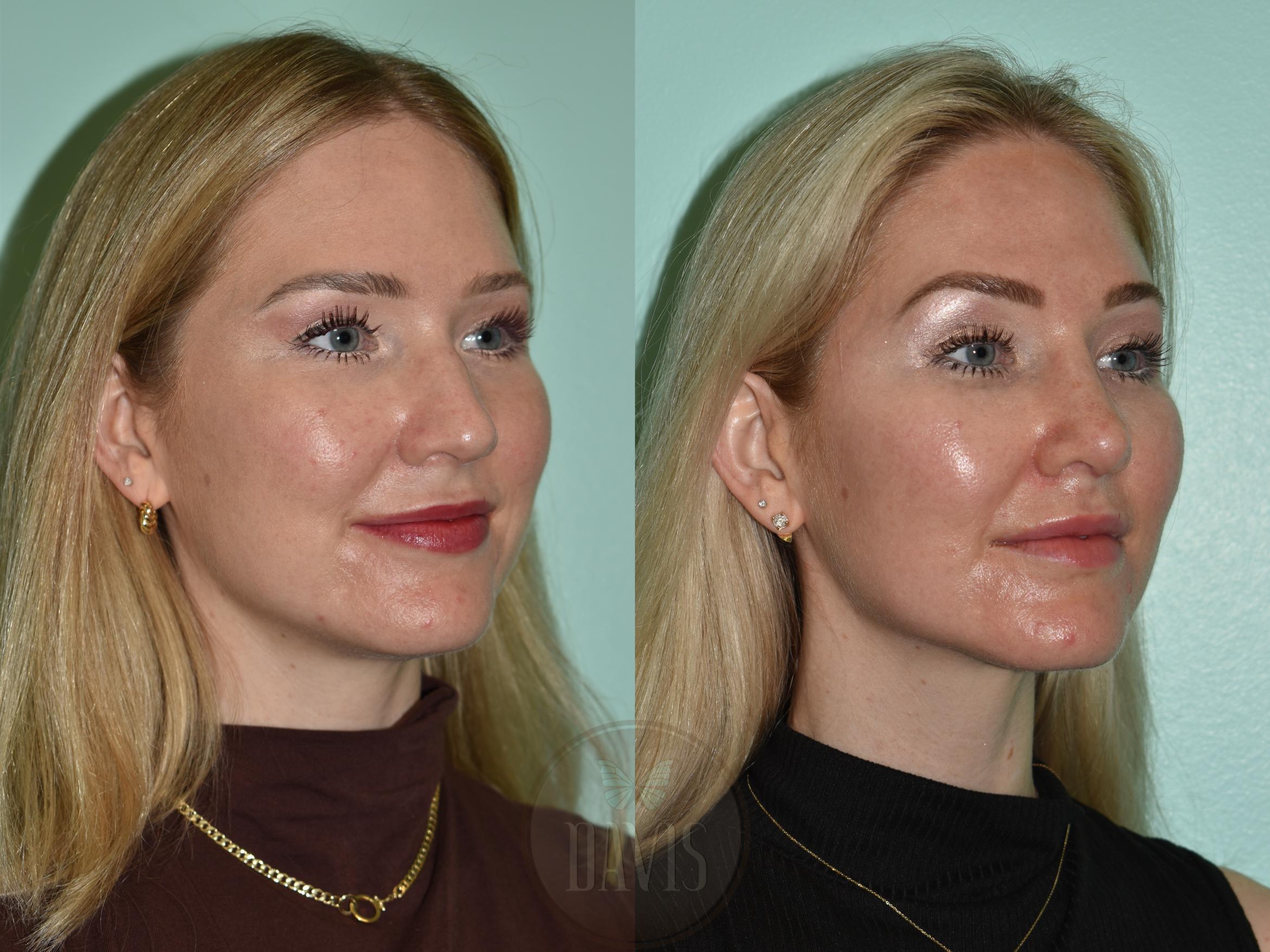 Before & After Female Rhinoplasty Case 1176 Left Oblique View in Tampa, FL