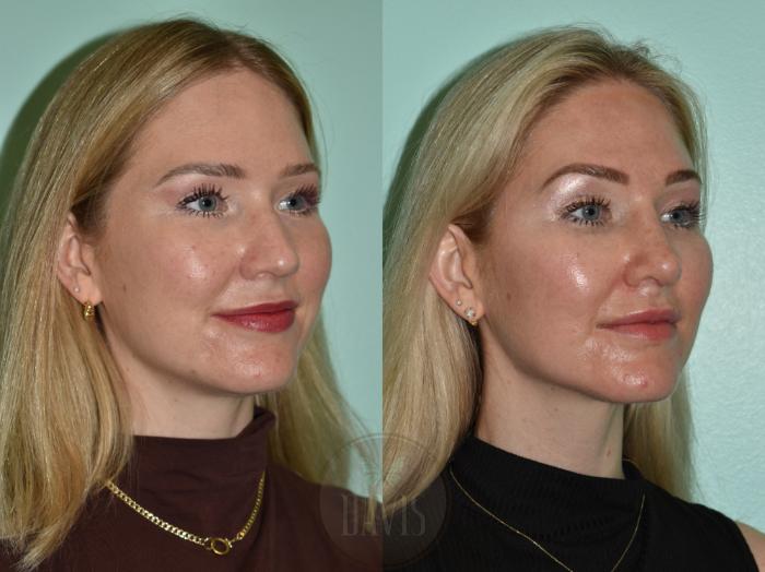 Before & After Female Rhinoplasty Case 1176 Left Oblique View in Tampa, FL