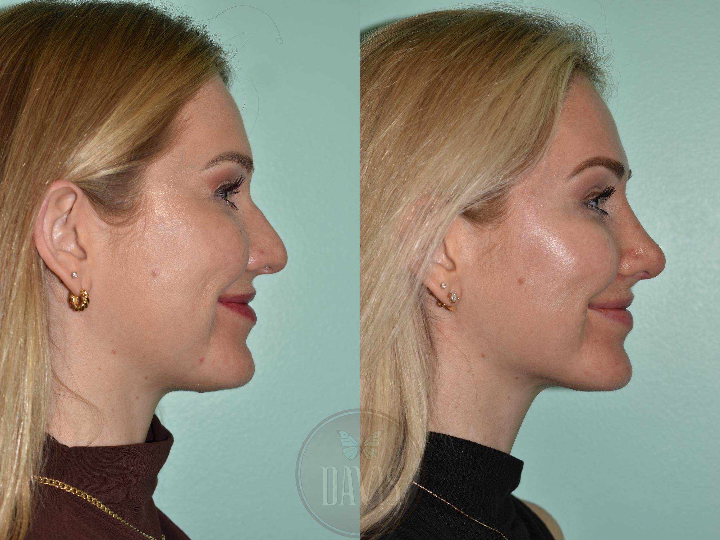Before & After Female Rhinoplasty Case 1176 Left Side View in Tampa, FL