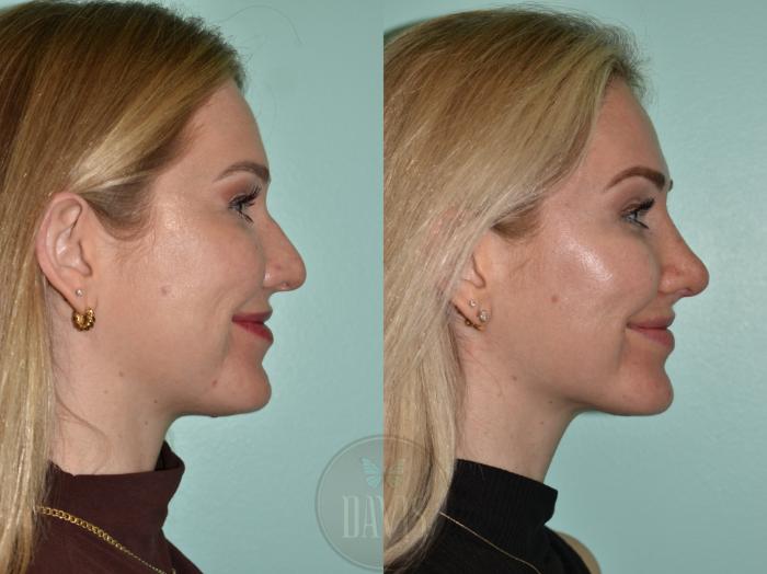 Before & After Female Rhinoplasty Case 1176 Left Side View in Tampa, FL