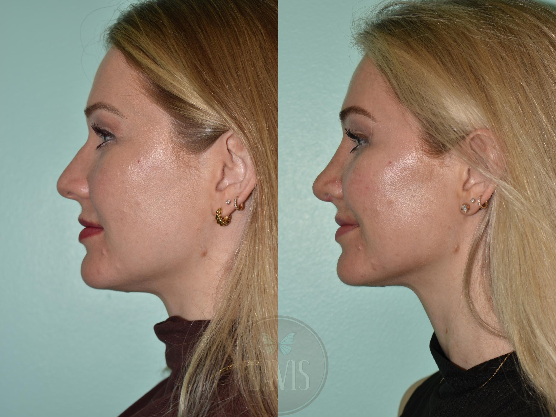Before & After Female Rhinoplasty Case 1176 Right Side View in Tampa, FL