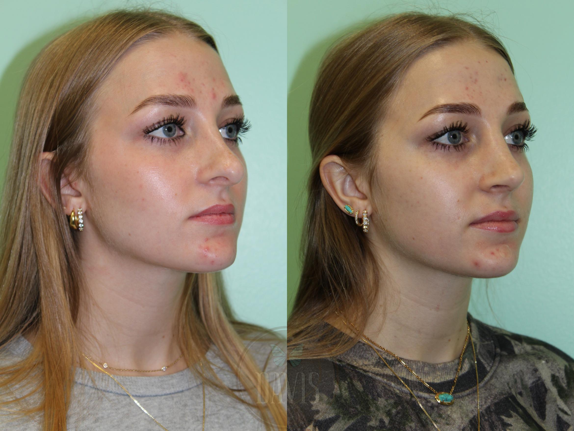 Before & After Female Rhinoplasty Case 1177 Front View in Tampa, FL