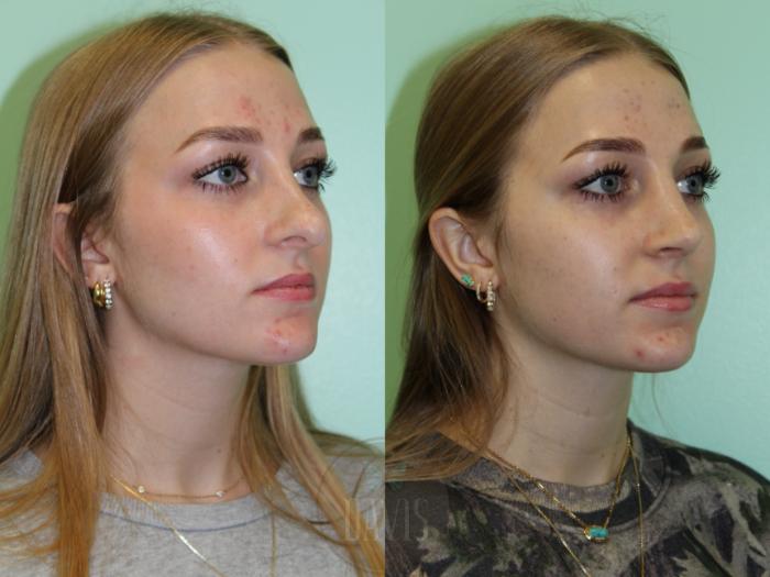 Before & After Female Rhinoplasty Case 1177 Front View in Tampa, FL