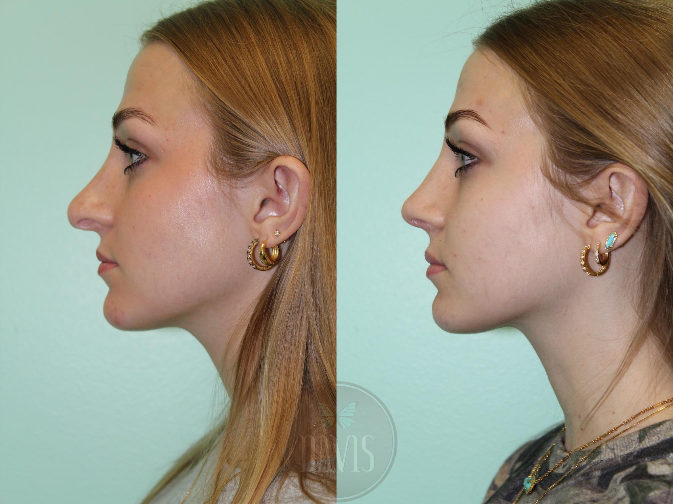 Before & After Female Rhinoplasty Case 1177 Left Oblique View in Tampa, FL