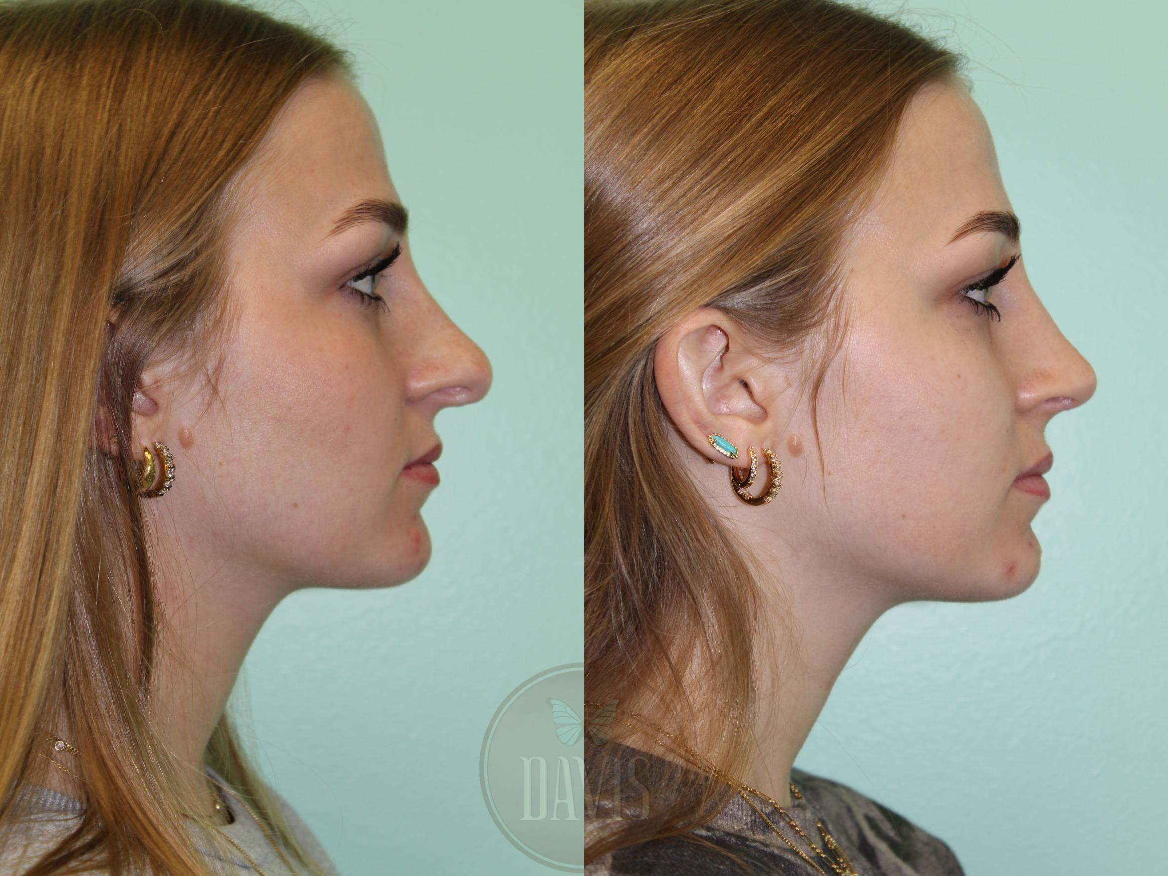 Before & After Female Rhinoplasty Case 1177 Left Side View in Tampa, FL