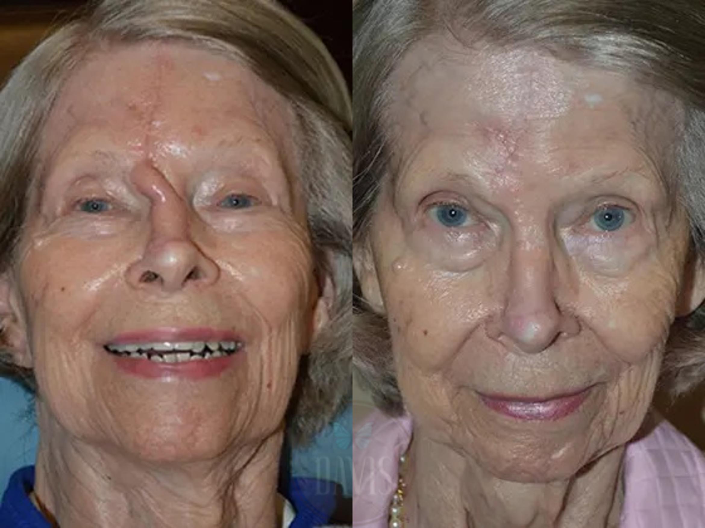Before & After Forehead Flap Nasal Reconstruction Case 1047 View 1 View in Tampa, FL