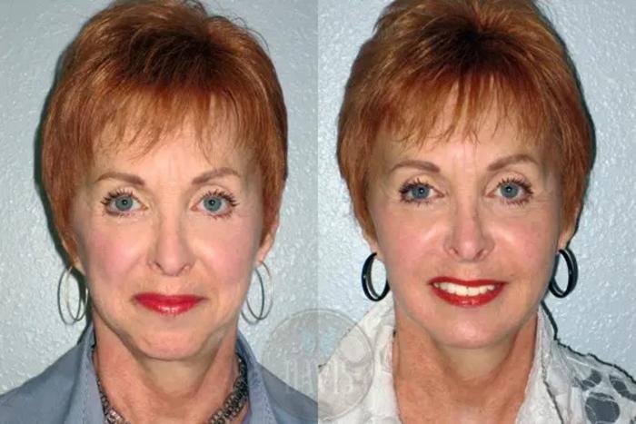Before & After Malar/Cheek Augmentation Case 1045 View 1 View in Tampa, FL