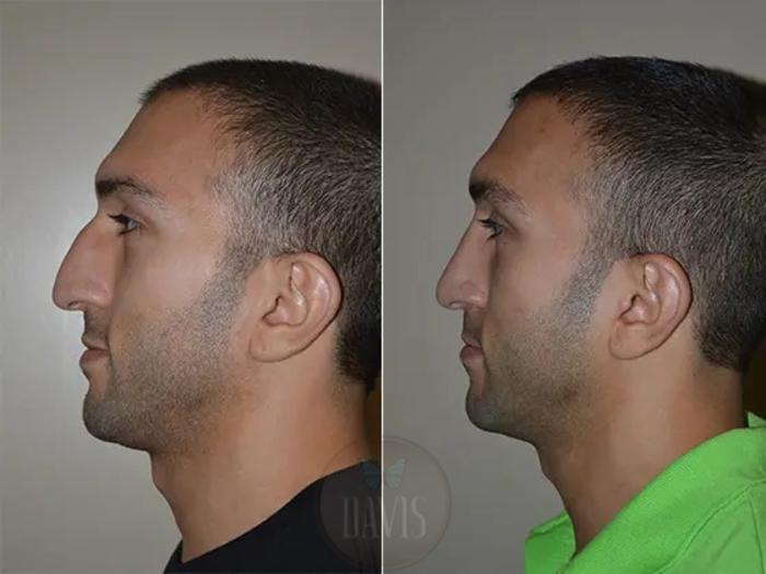 Before & After Male Rhinoplasty Case 1037 View 1 View in Tampa, FL