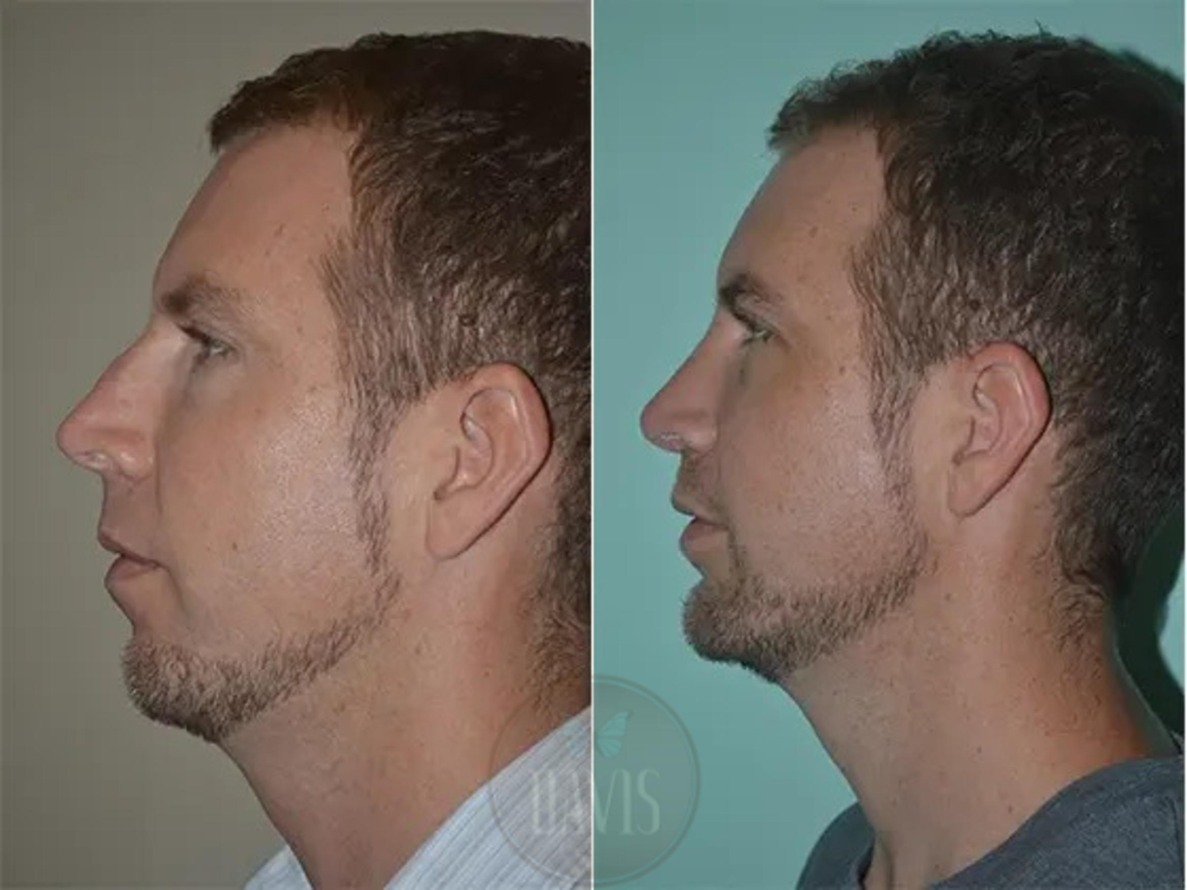 Before & After Male Rhinoplasty Case 1038 View 1 View in Tampa, FL