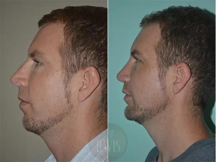 Before & After Male Rhinoplasty Case 1038 View 1 View in Tampa, FL