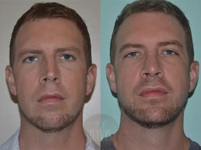 Before & After Male Rhinoplasty Case 1038 View 2 View in Tampa, FL
