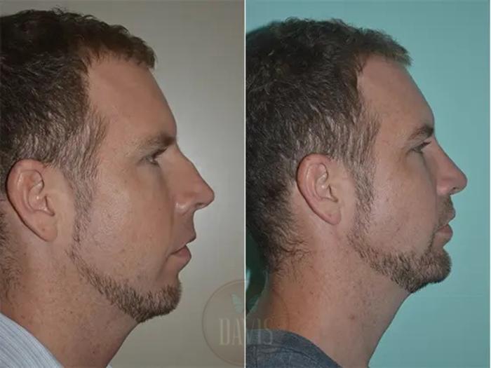 Before & After Male Rhinoplasty Case 1038 View 3 View in Tampa, FL