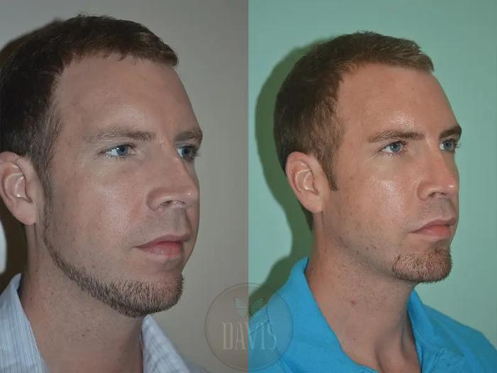 Before & After Male Rhinoplasty Case 1038 View 4 View in Tampa, FL