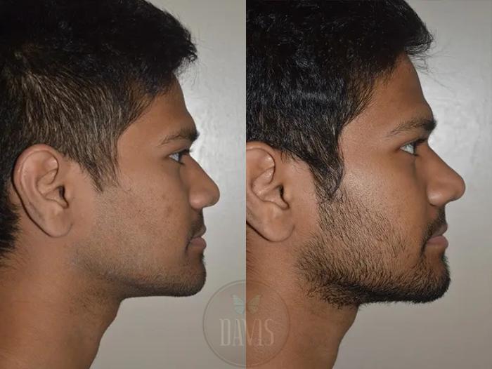 Before & After Male Rhinoplasty Case 1039 View 1 View in Tampa, FL