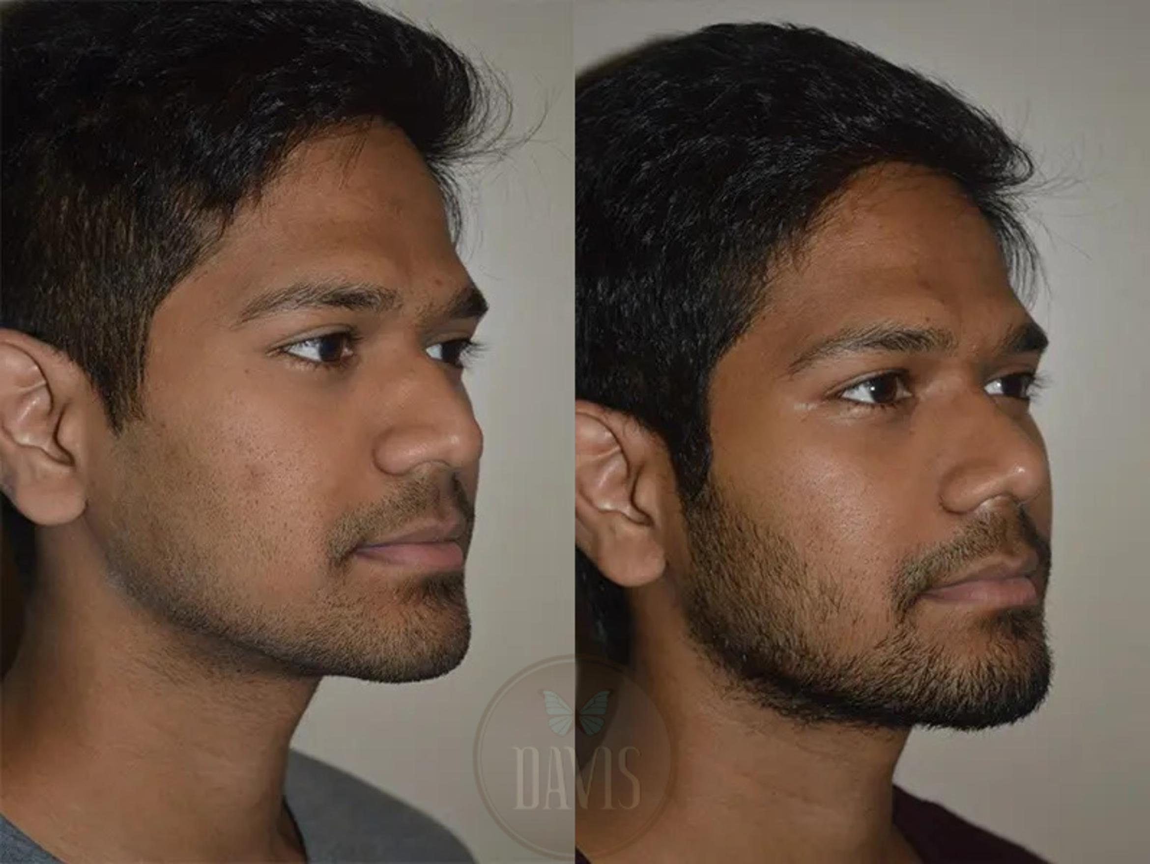 Before & After Male Rhinoplasty Case 1039 View 2 View in Tampa, FL