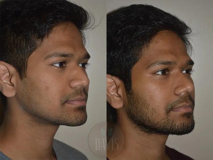 Before & After Male Rhinoplasty Case 1039 View 2 View in Tampa, FL