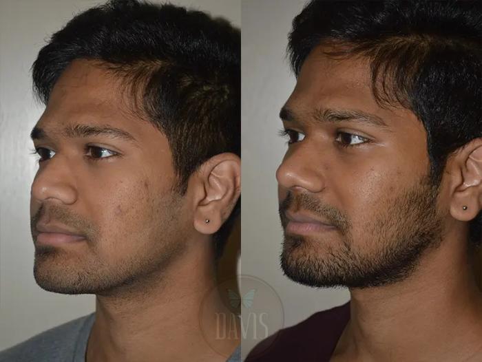 Before & After Male Rhinoplasty Case 1039 View 3 View in Tampa, FL