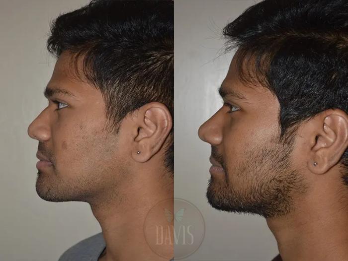 Before & After Male Rhinoplasty Case 1039 View 4 View in Tampa, FL