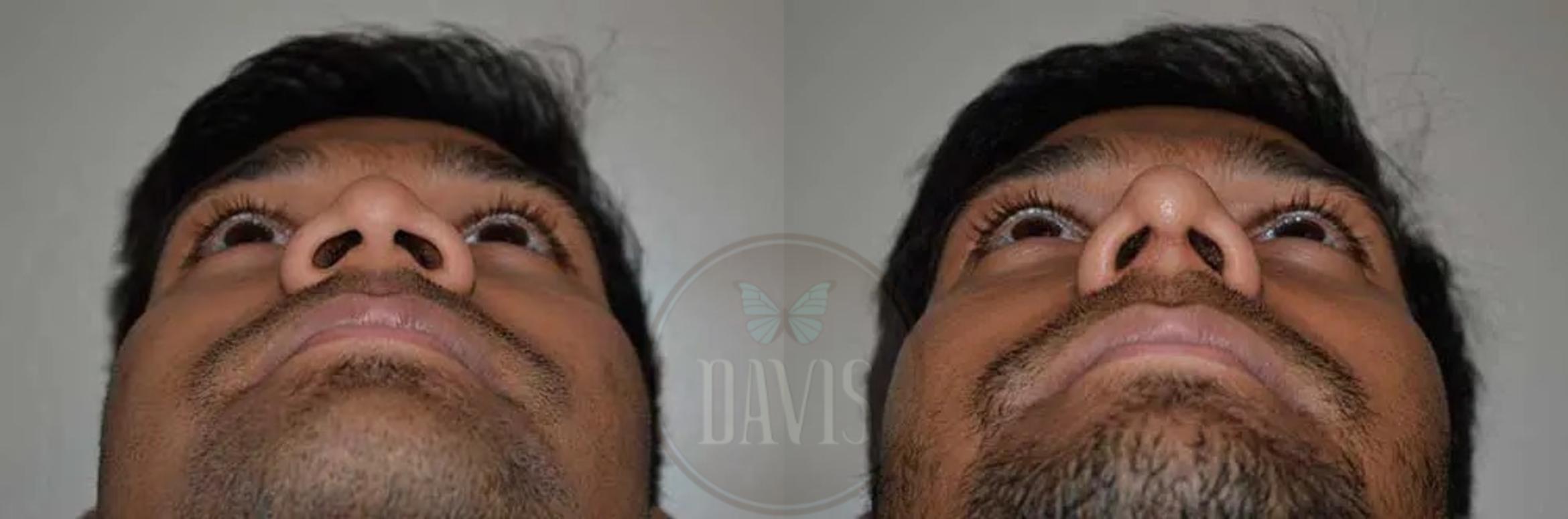 Before & After Male Rhinoplasty Case 1039 View 5 View in Tampa, FL