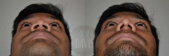 Before & After Male Rhinoplasty Case 1039 View 5 View in Tampa, FL