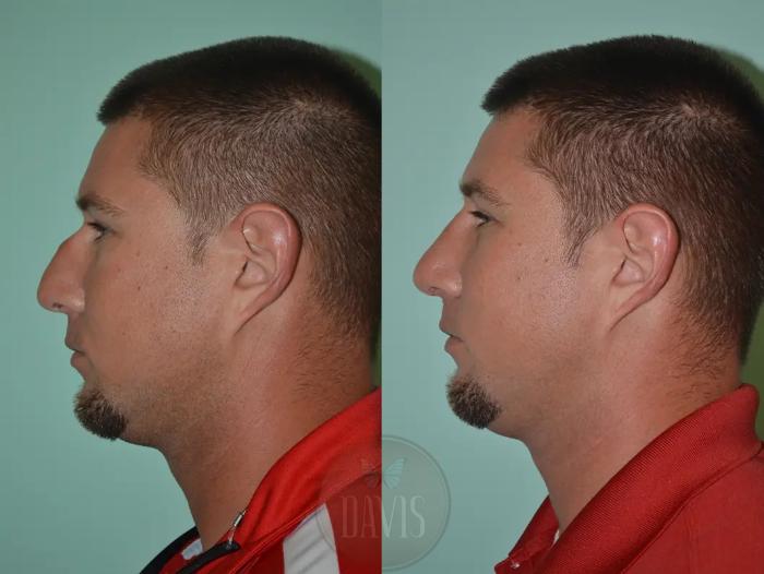 Before & After Male Rhinoplasty Case 1040 View 1 View in Tampa, FL