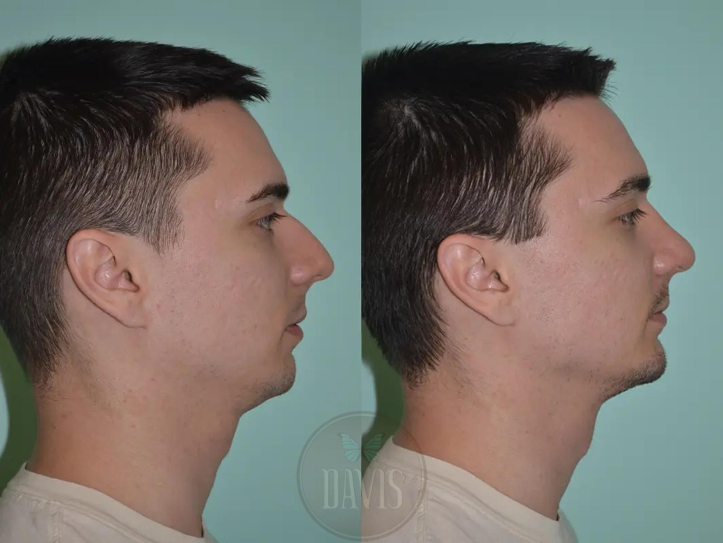 Before & After Male Rhinoplasty Case 1041 View 1 View in Tampa, FL