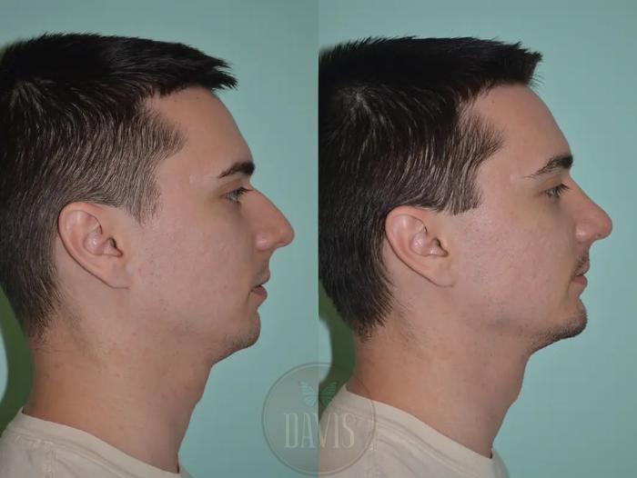 Before & After Male Rhinoplasty Case 1041 View 1 View in Tampa, FL