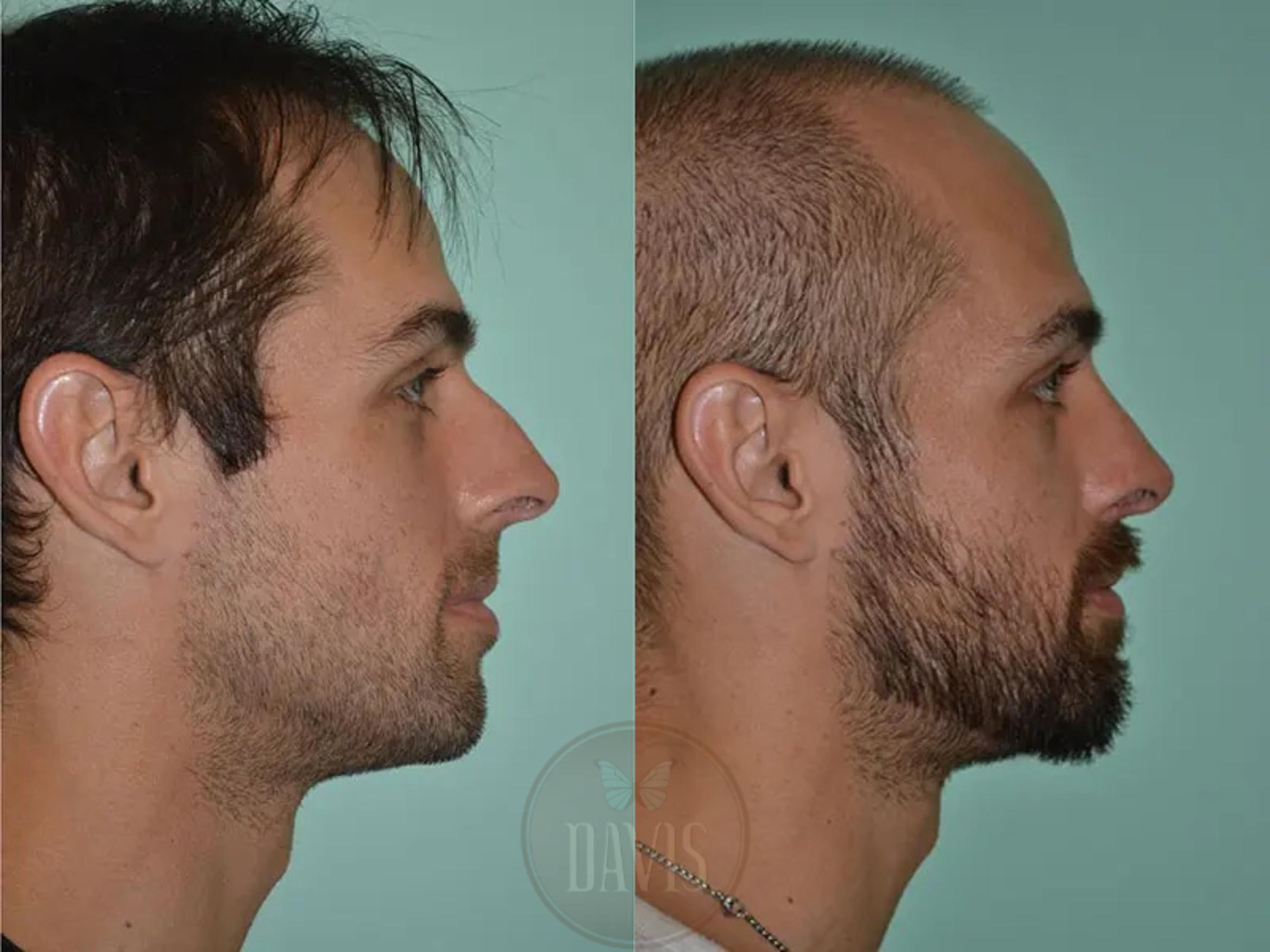 Before & After Male Rhinoplasty Case 1042 View 1 View in Tampa, FL
