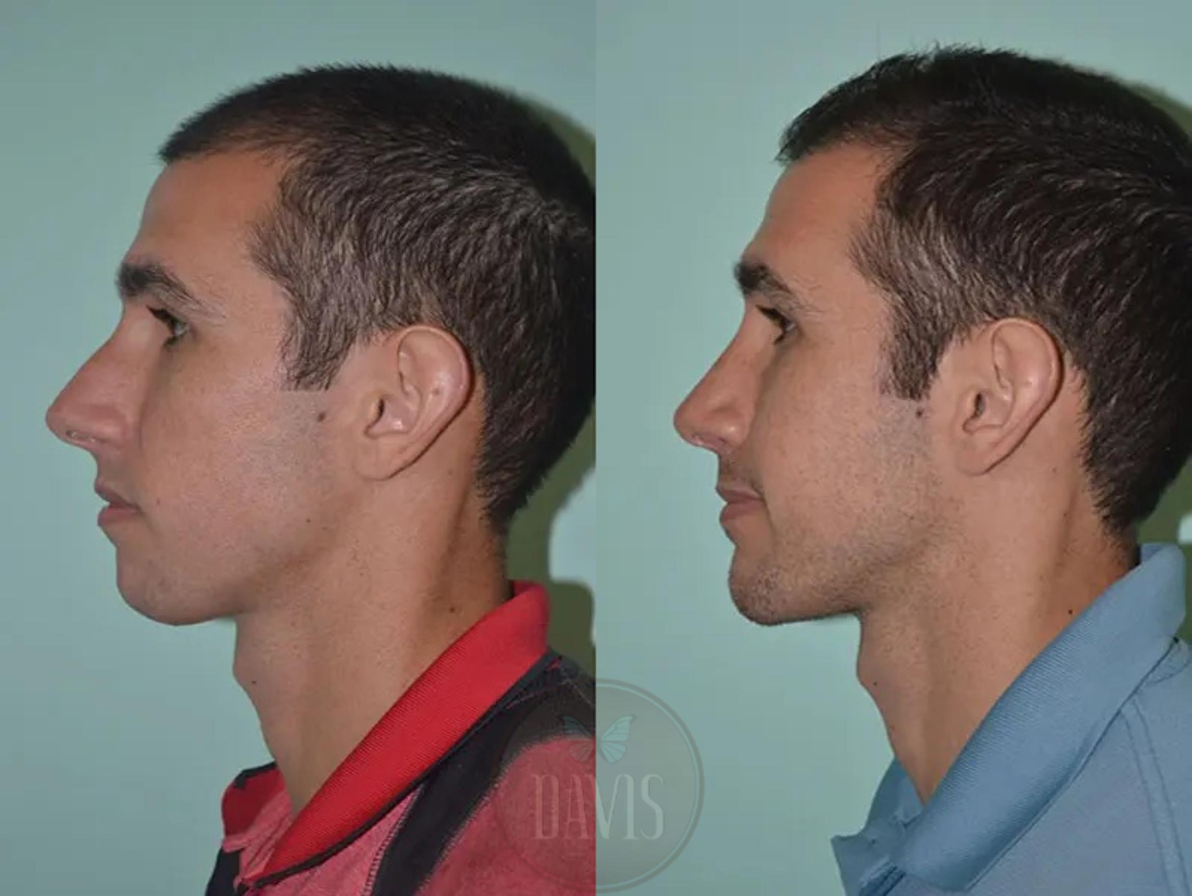 Before & After Male Rhinoplasty Case 1043 View 1 View in Tampa, FL