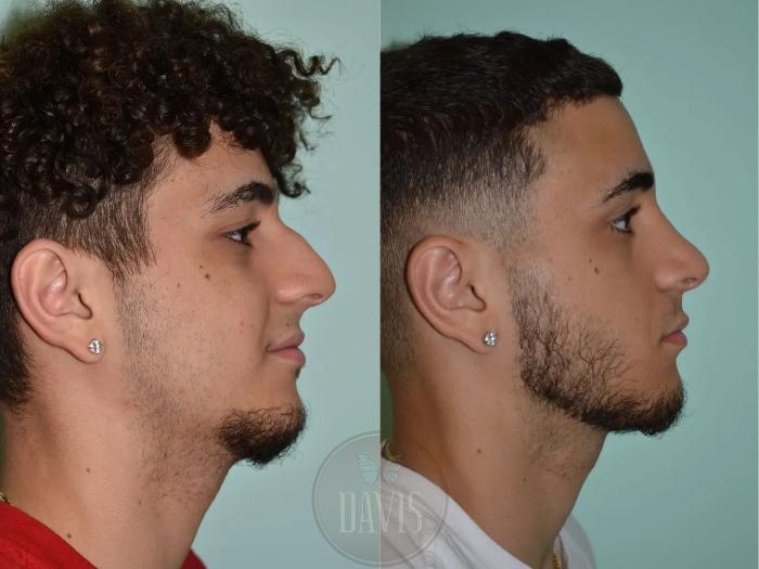 Before & After Male Rhinoplasty Case 1044 View 1 View in Tampa, FL