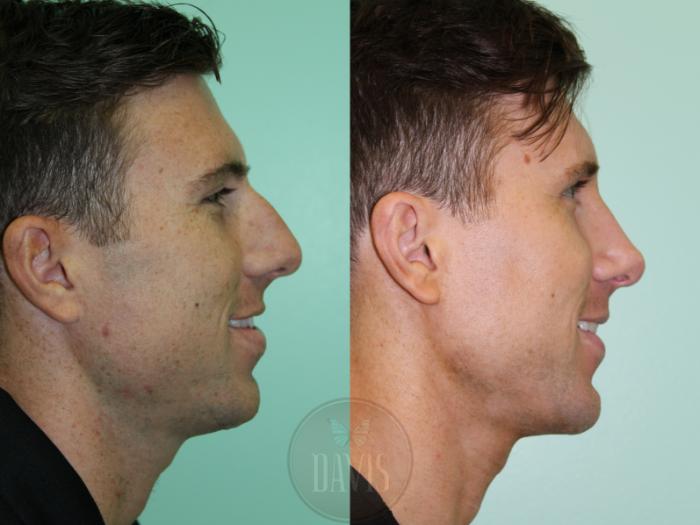 Before & After Male Rhinoplasty Case 1168 Left Oblique View in Tampa, FL