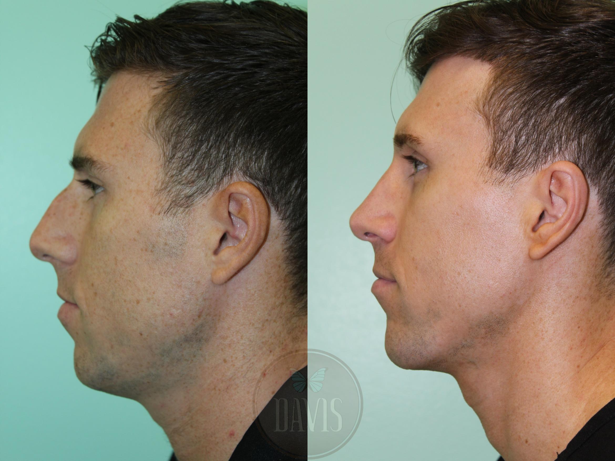Before & After Male Rhinoplasty Case 1168 Left Side View in Tampa, FL