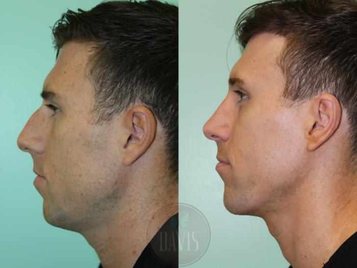 Before & After Male Rhinoplasty Case 1168 Left Side View in Tampa, FL