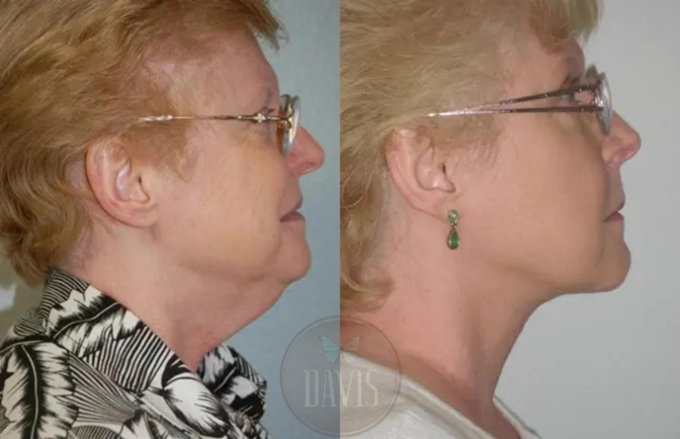 Before & After Neck Lift Case 1030 View 1 View in Tampa, FL