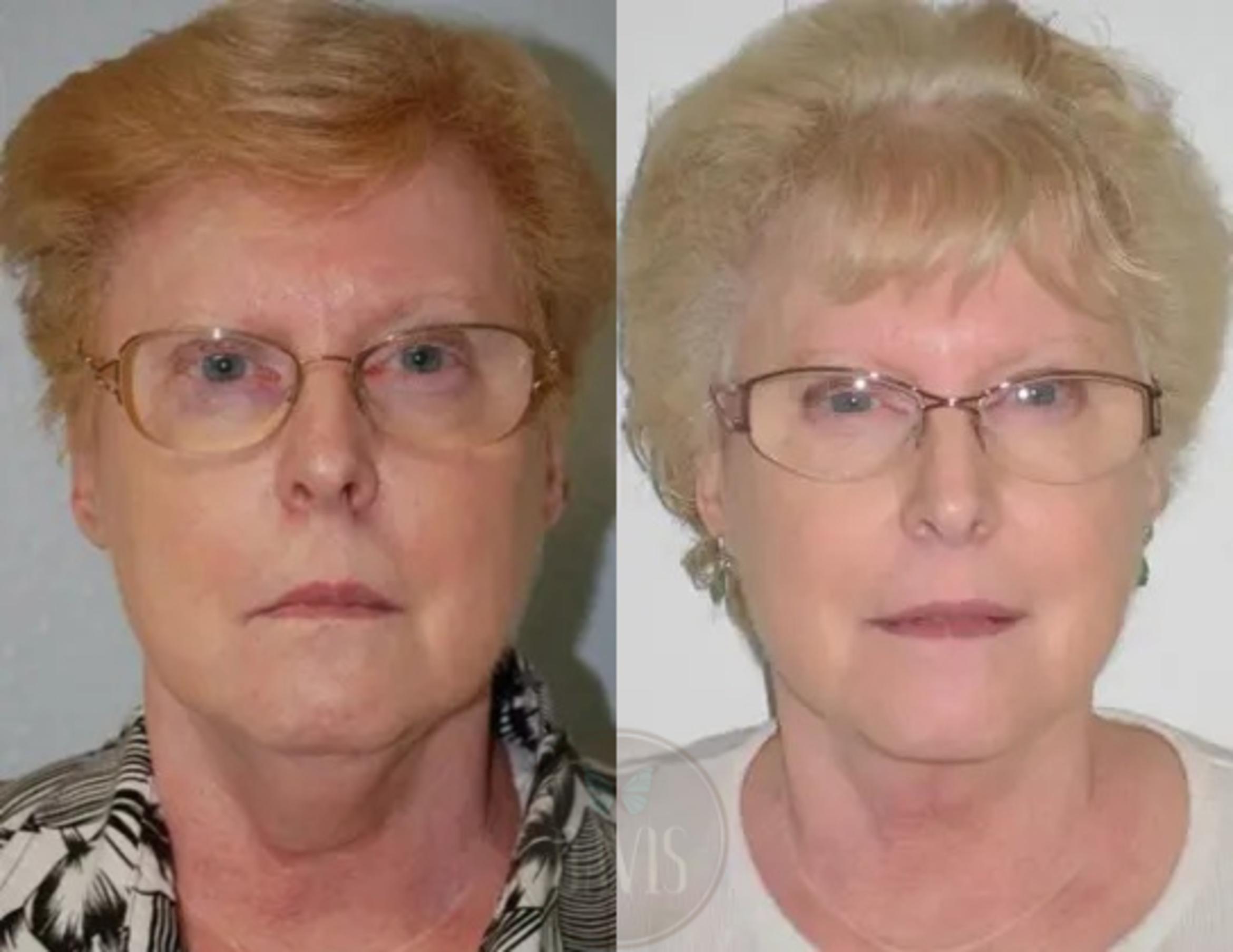 Before & After Neck Lift Case 1030 View 2 View in Tampa, FL