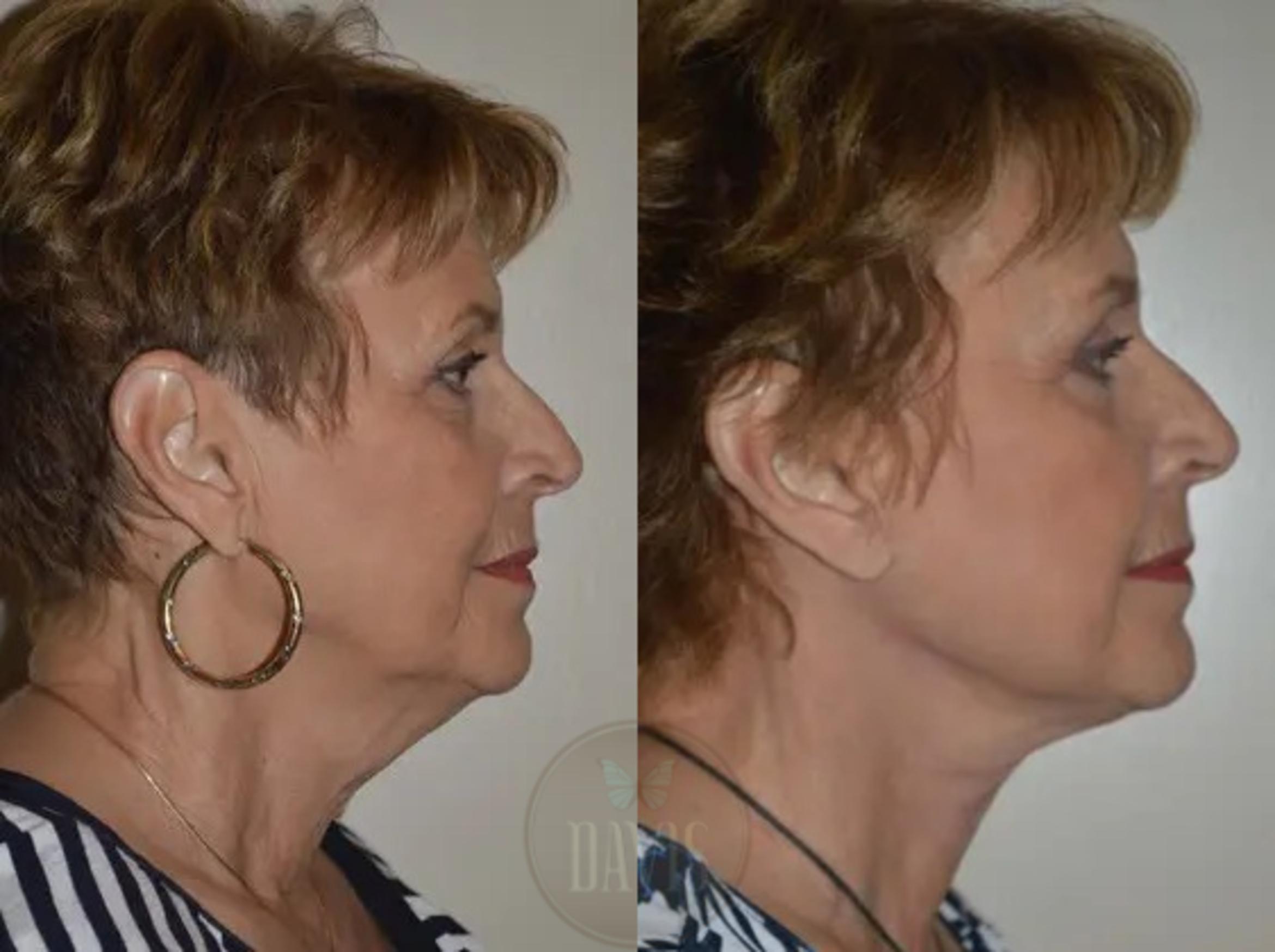 Before & After Neck Lift Case 1031 View 1 View in Tampa, FL