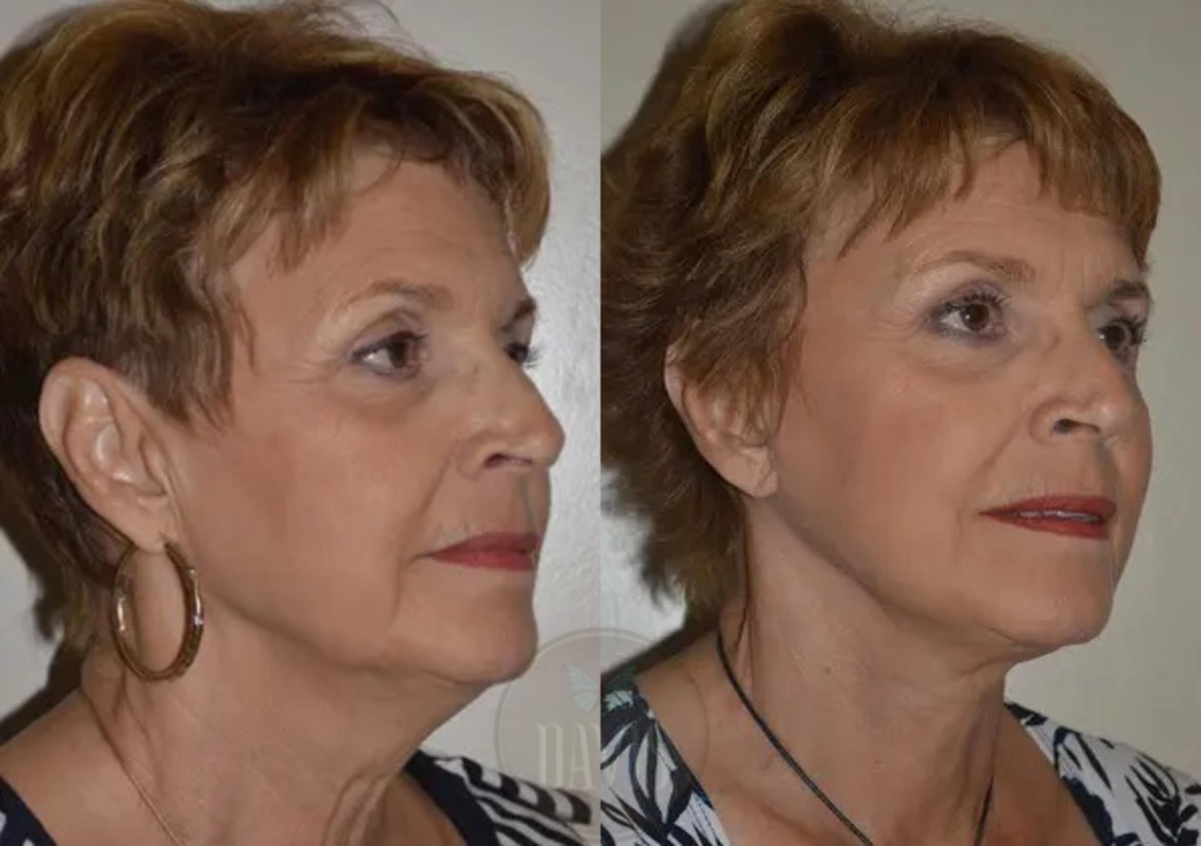 Before & After Neck Lift Case 1031 View 2 View in Tampa, FL