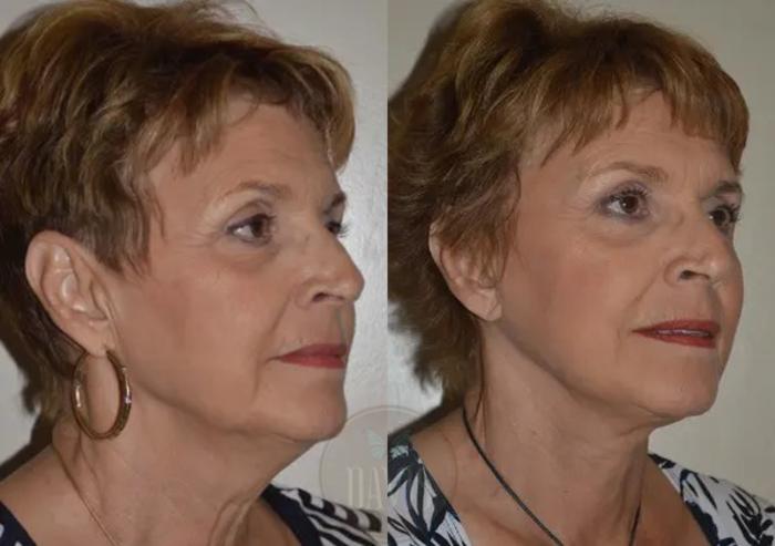 Before & After Neck Lift Case 1031 View 2 View in Tampa, FL