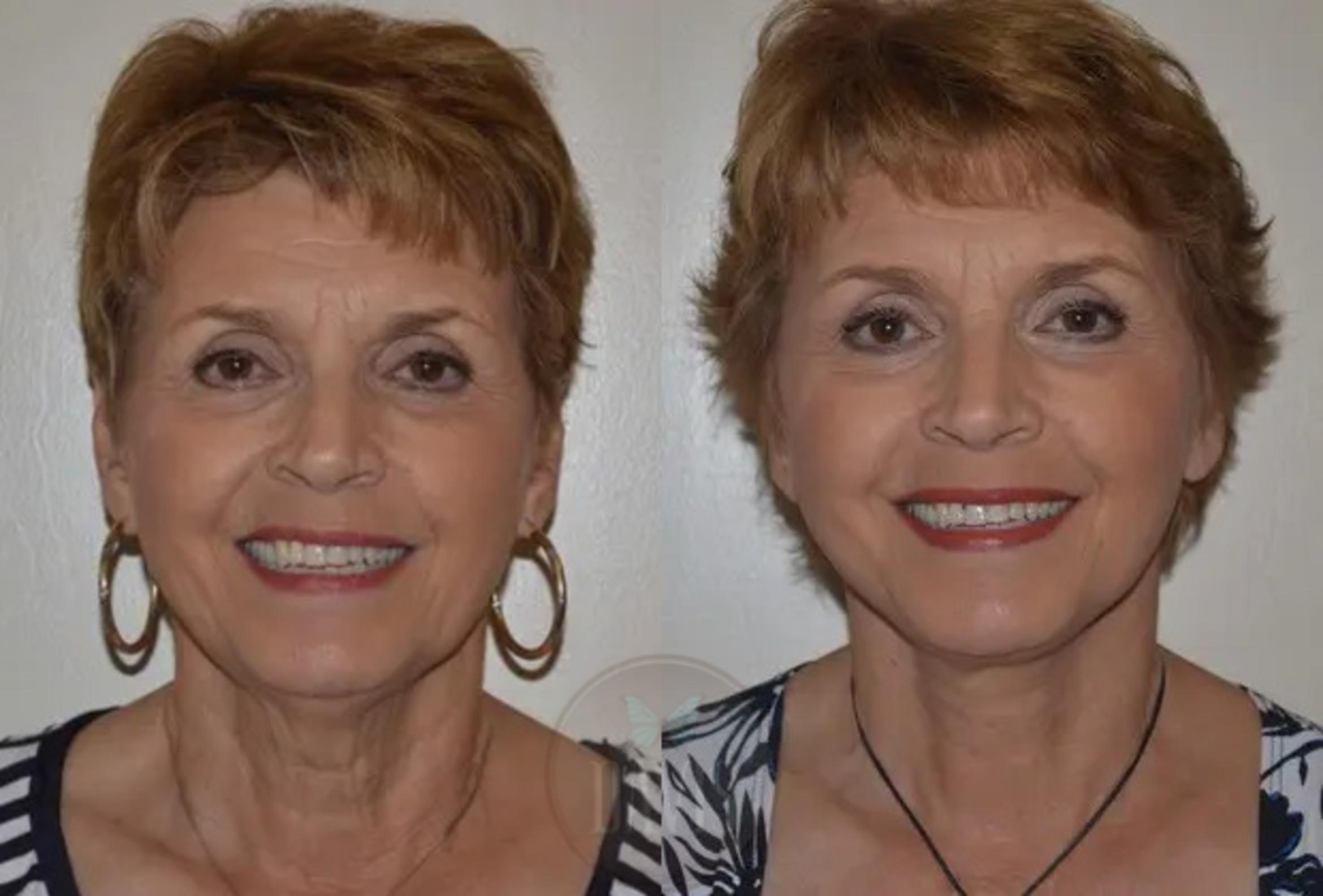 Before & After Neck Lift Case 1031 View 3 View in Tampa, FL