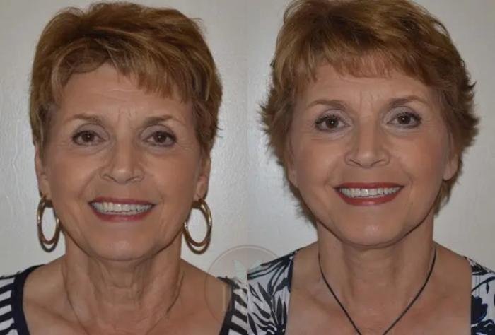 Before & After Neck Lift Case 1031 View 3 View in Tampa, FL