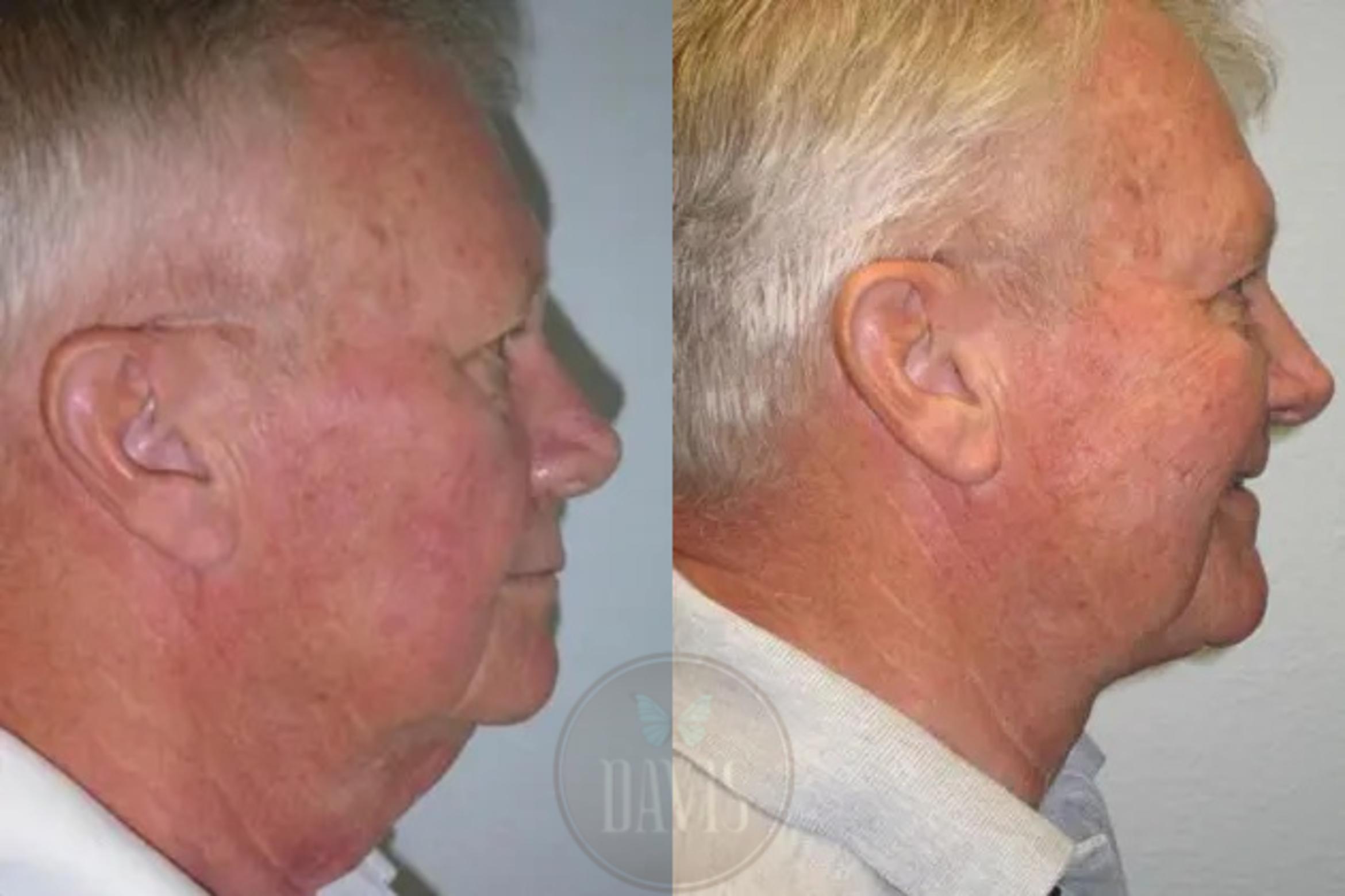 Before & After Neck Lift Case 1032 View 1 View in Tampa, FL